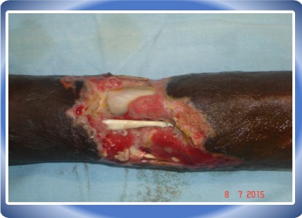 LOWER LIMB INJURY